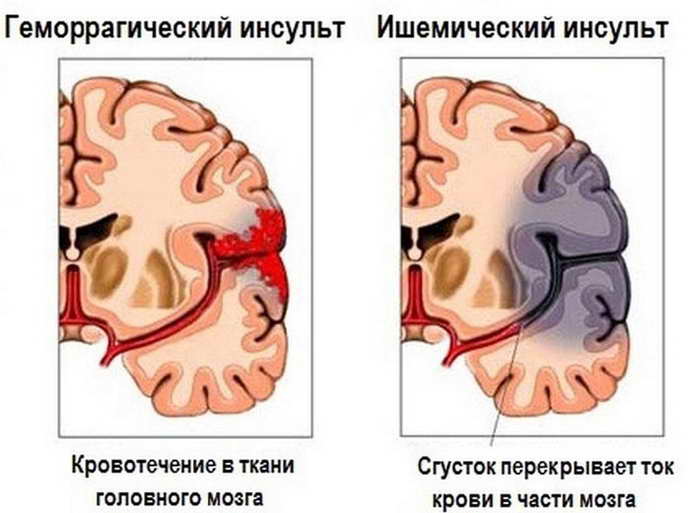 различия инсульта