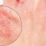 Как выглядит дерматит на руках