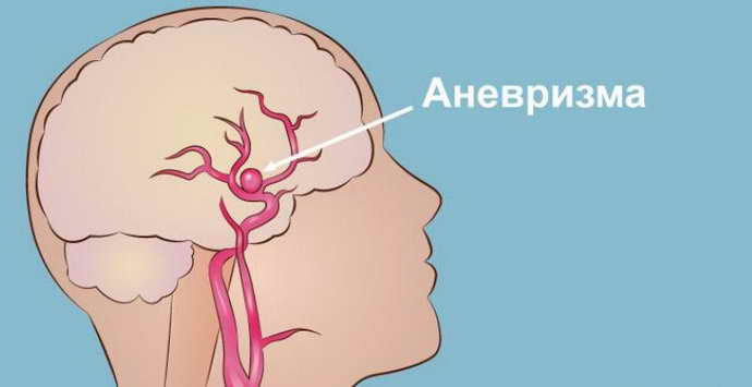 Разрыв аневризмы сосудов головного мозга