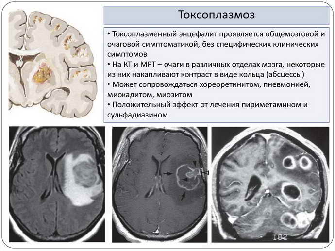 токсоплазмоз головного мозга классификация