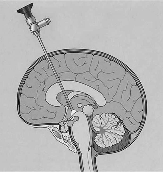 Пункционный способ биопсии мозга