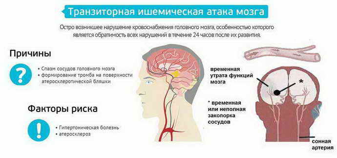 Ишемическая атака головного мозга