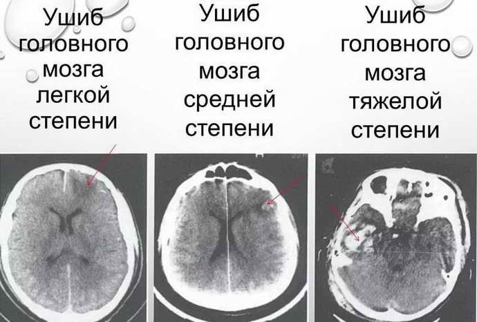 Что такое ушиб мозга