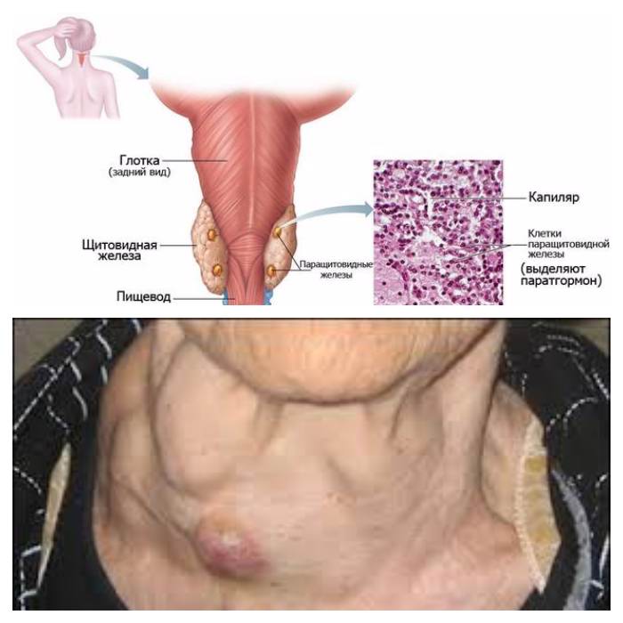 Причины удаления щитовидной железы у женщин