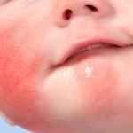 Аллергический дерматит у малыша