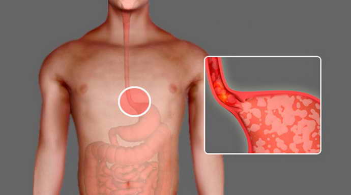 Особенности возникновения симптома болезни желудка при иостеохондрозе
