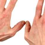 аллергический дерматит фото у взрослых на руках