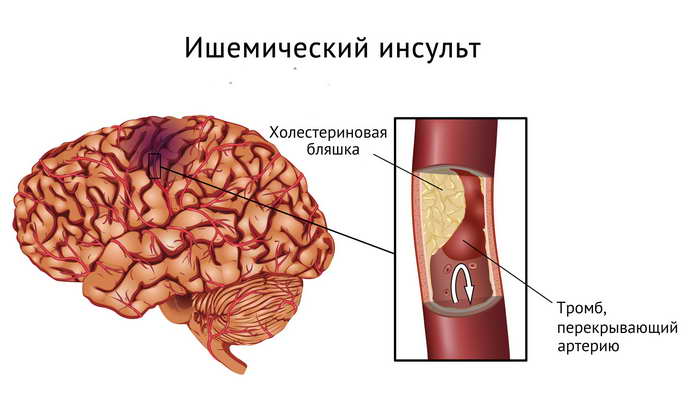 инсульт мозжечка и его виды