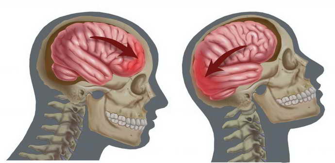 гематома головного мозга
