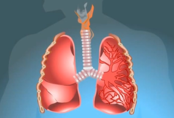Легочная форма туберкулёза