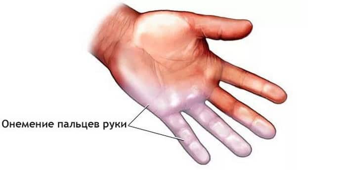 Как решается проблема онемения левой руки