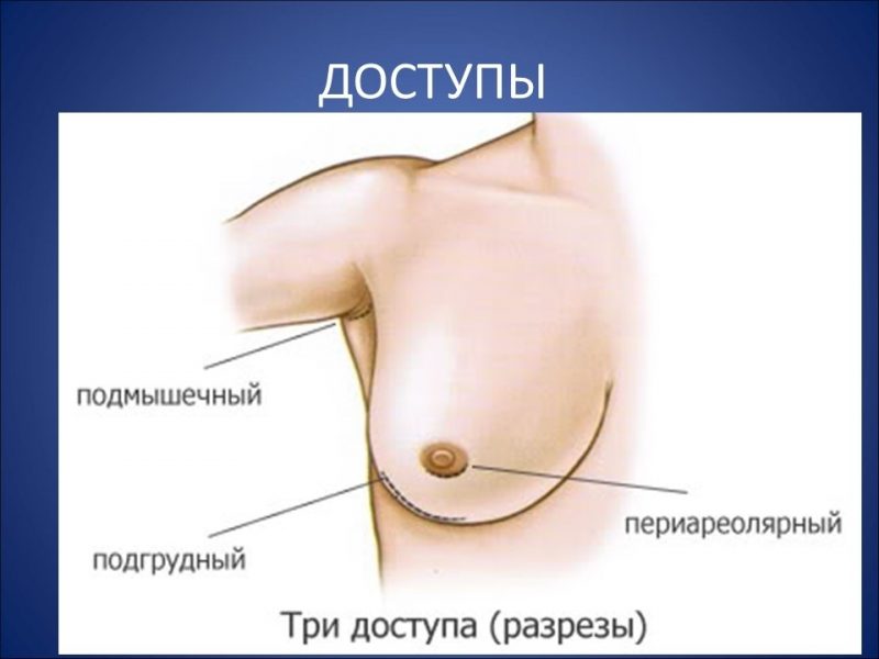 Операция по увеличению грудных желез