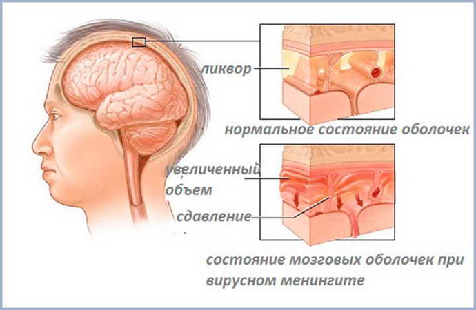 гидроцефалия головного мозга