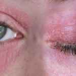 Фото аллергического дерматита на глазах