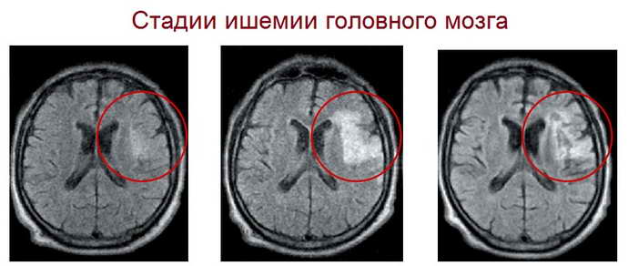 что такое ишемия головного мозга