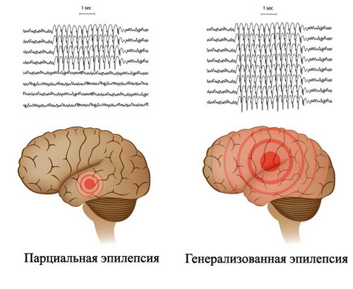 3 вида эпилепсии
