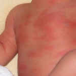 пеленочный дерматит фото у детей