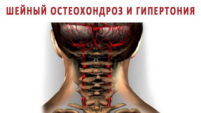 шейный остеохондроз и артериальное давление