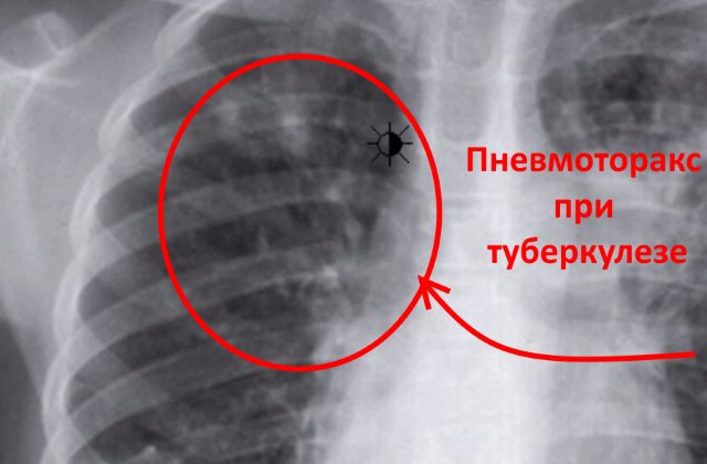 Пневмоторакс на рентгене при туберкулезе легких