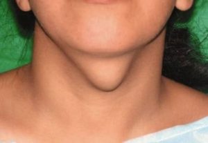 увеличенная щитовидная железа