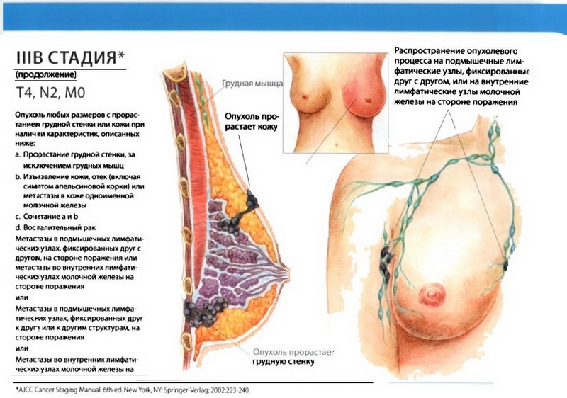 Рак молочной железы 3 стадия