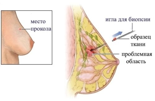 пункция молочной железы