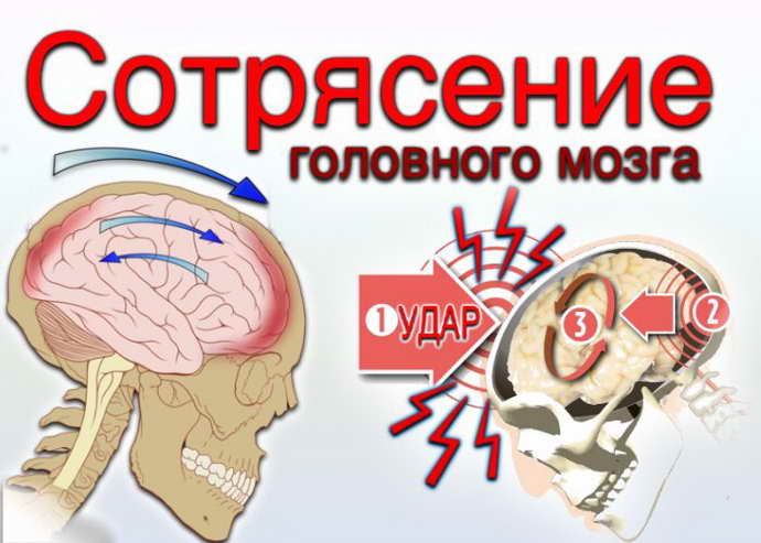 головной мозг сотрясение