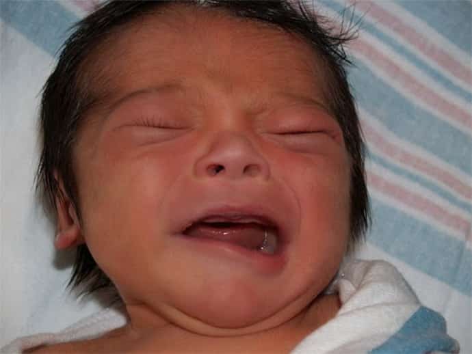 парез лицевого нерва у новорожденных