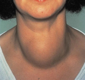 зоб щитовидной железы