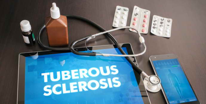 Что такое туберозный склероз, причины возникновения, симптомы и лечение заболевания