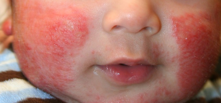 дерматит на лице ребёнка