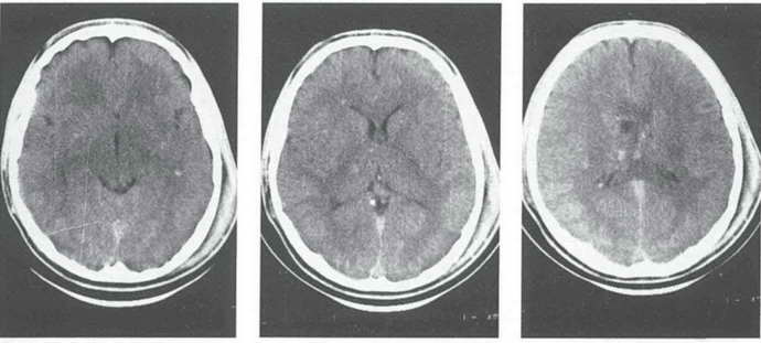 диффузное аксональное повреждение головного мозга диагностика