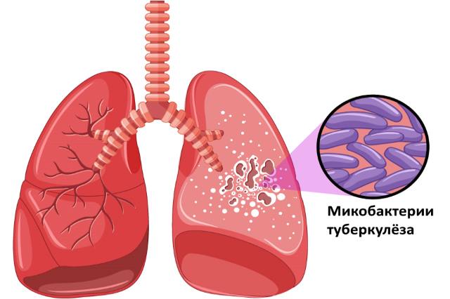Микобактерии туберкулёза в лёгких
