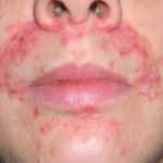 Фото аллергического дерматита на лице у взрослого