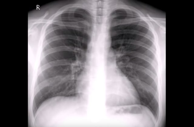 Рентген грудной клетки при диагностике заболевания