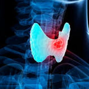 Рак щитовидной железы сколько живут после операции?