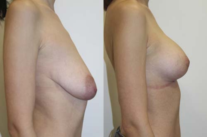 Подтяжка грудных желез без имплантов