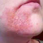 фото атопического дерматита на лице