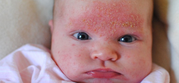 Кожный дерматит на лице у ребенка