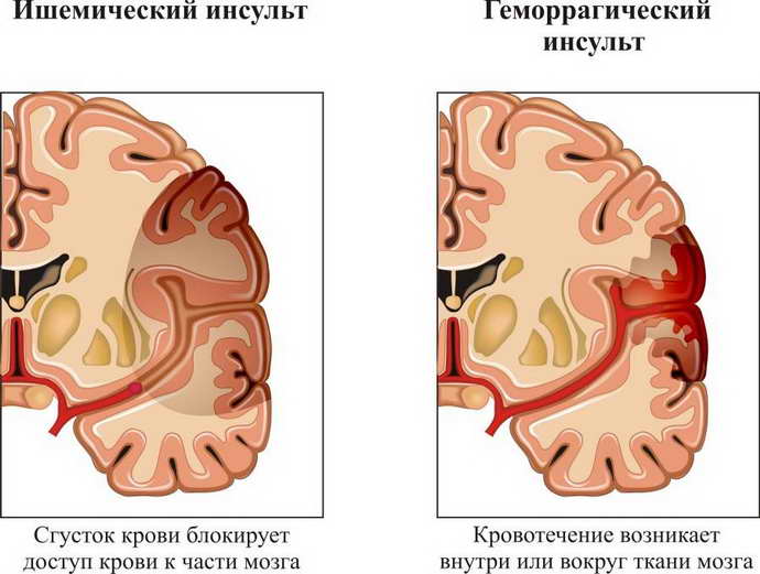 Какие заболевания мозга могут привести к нарушению вестибулярной функции