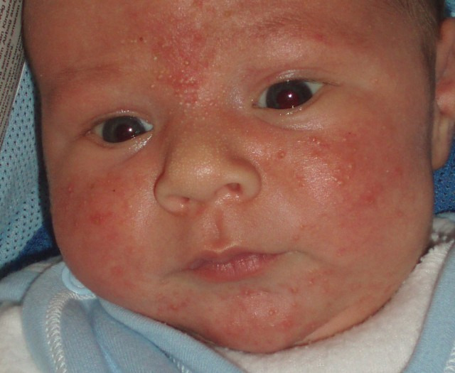 Себорейный дерматит на лице у ребенка