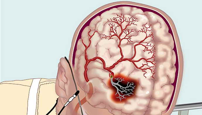 Атеросклероз церебральных сосудов головного мозга когда появляется