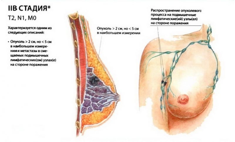 Рак молочной железы 2 стадия