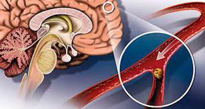 нарушение мозгового кровообращения при шейном остеохондрозе