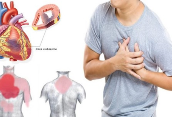 Микроинфаркт симптомы, первые признаки и лечение