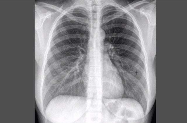 Пример рентген снимка грудной клетки