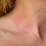 фото аллергического дерматита на шее у взрослого