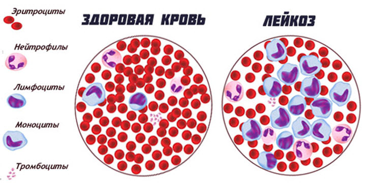 Что такое лимфолейкоз? Какие показатели должны быть в анализе крови при болезни?