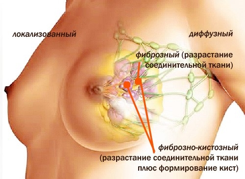 Аденоз молочной железы