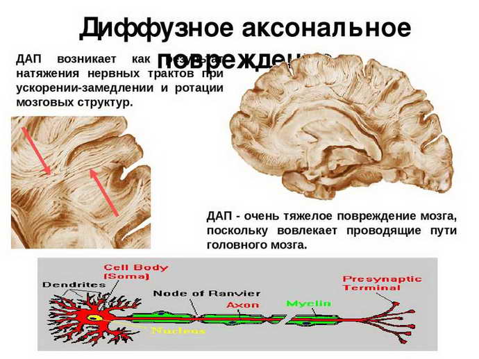 диффузное аксональное повреждение головного мозга